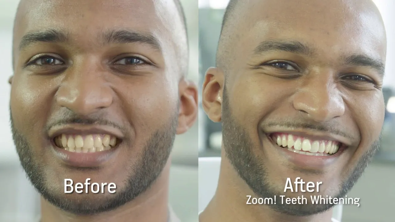 26032 zoom teeth whitening aftercare 6