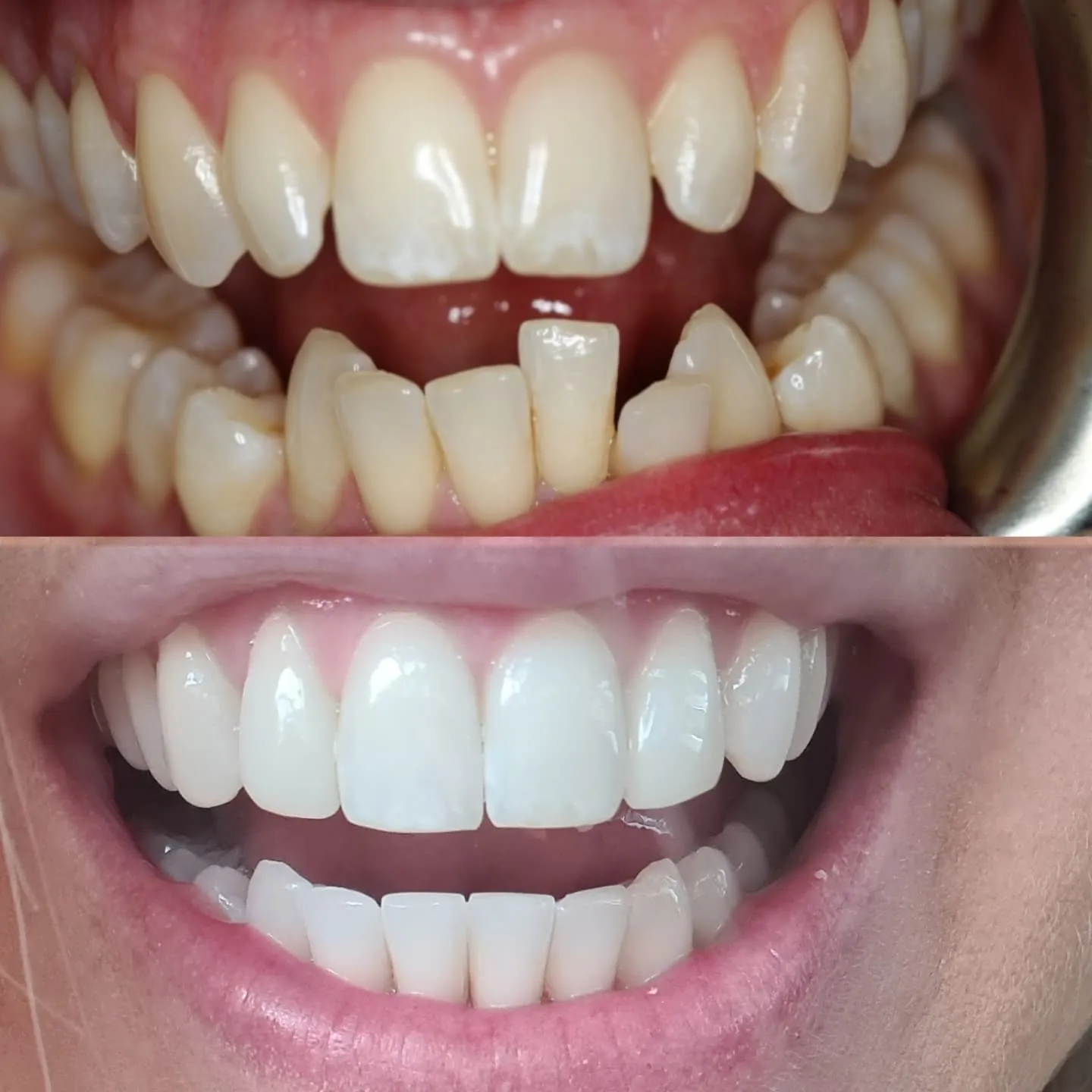 26034 charcoal teeth whitening