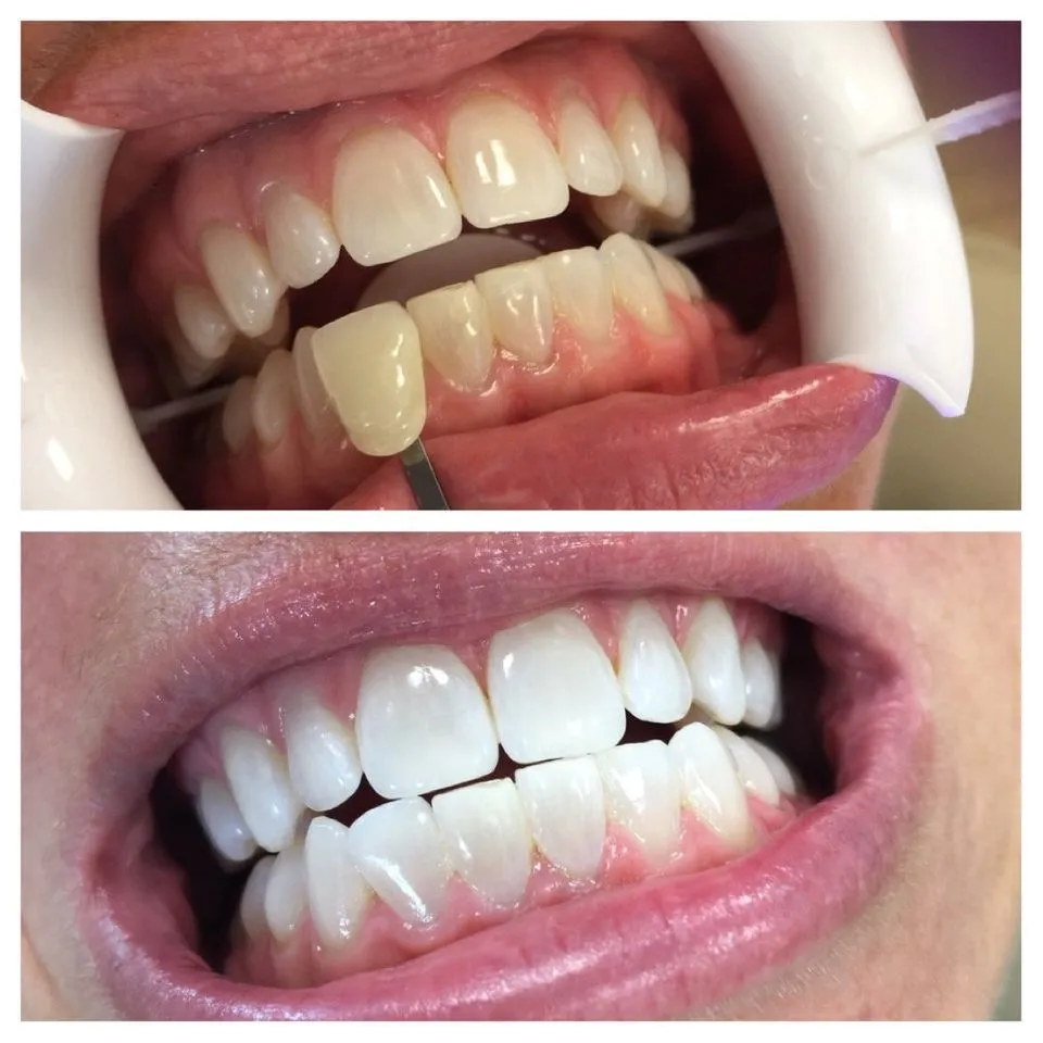 /img/26034-teeth-whitening-before-after.webp