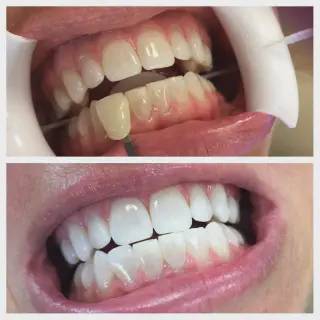 /img/26034-teeth-whitening-before-after.webp