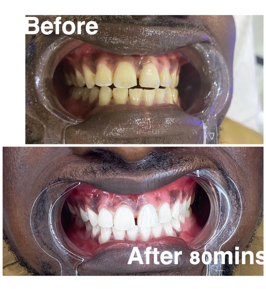 26043 teeth whitening customization