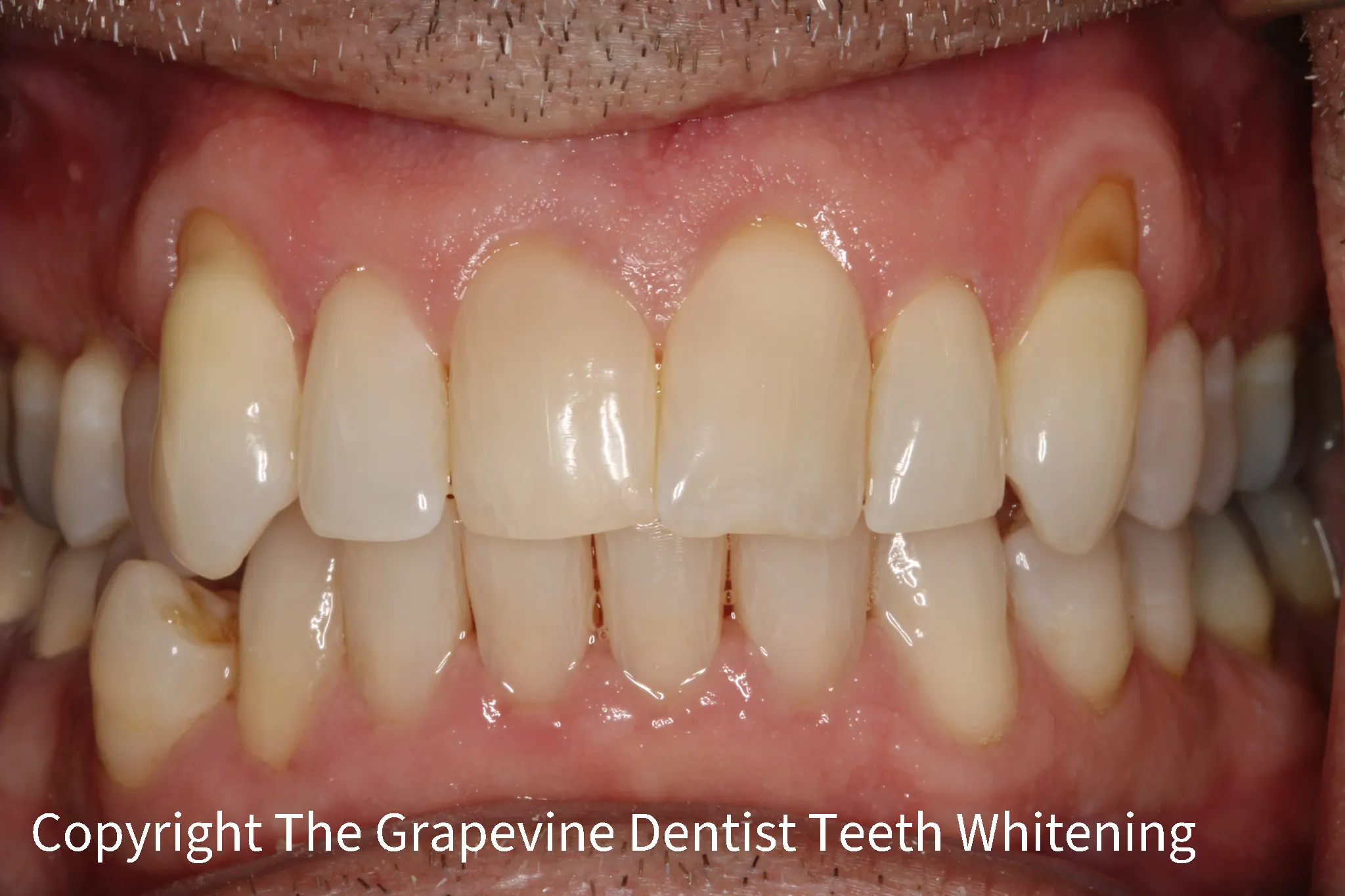 26044 white teeth diet staining foods image5