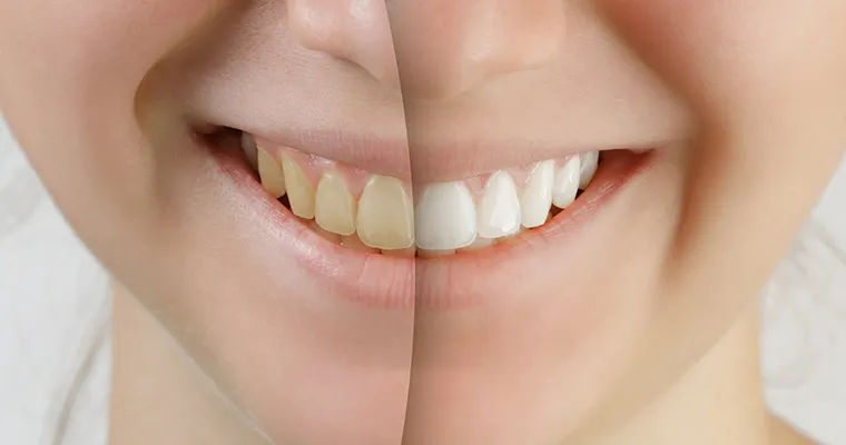 /img/26044-white-teeth-diet-teeth-whitening-image8.webp