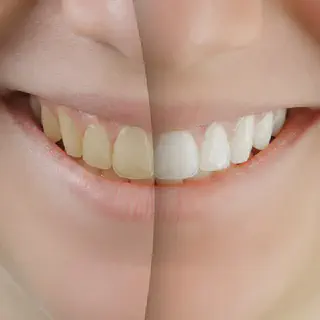 /img/26044-white-teeth-diet-teeth-whitening-image8.webp