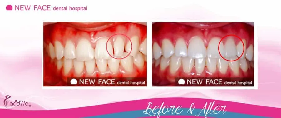 26046 in office teeth whitening