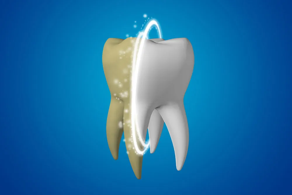 26047 teeth whitening results