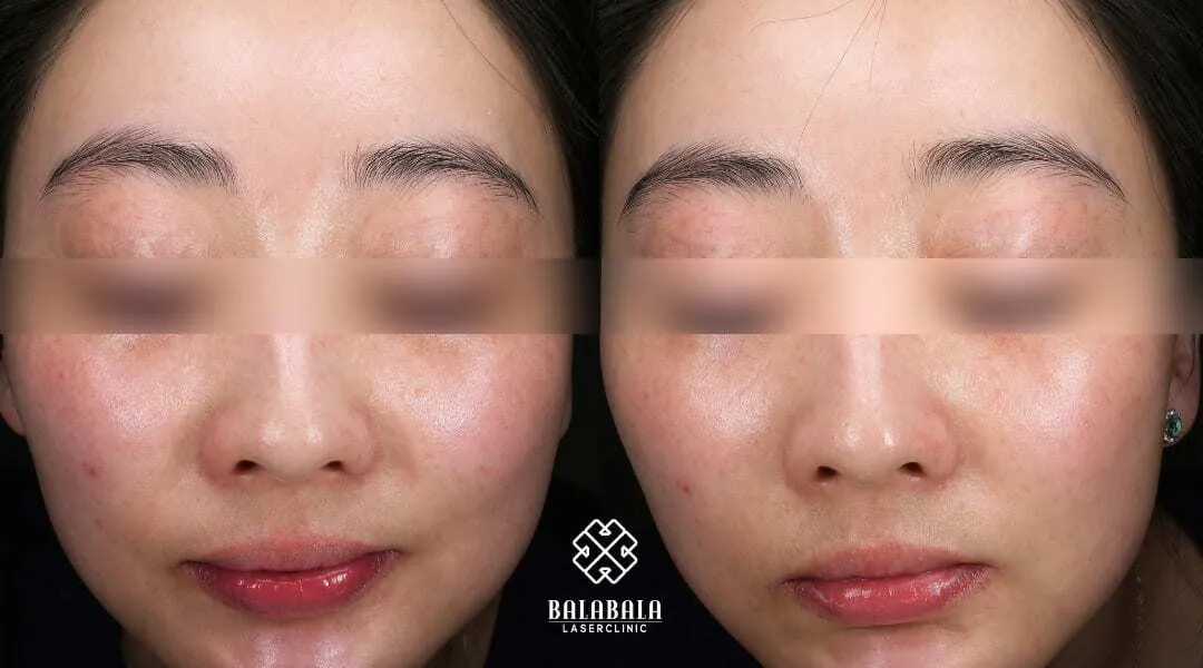 26048 mesotherapy skin whitening