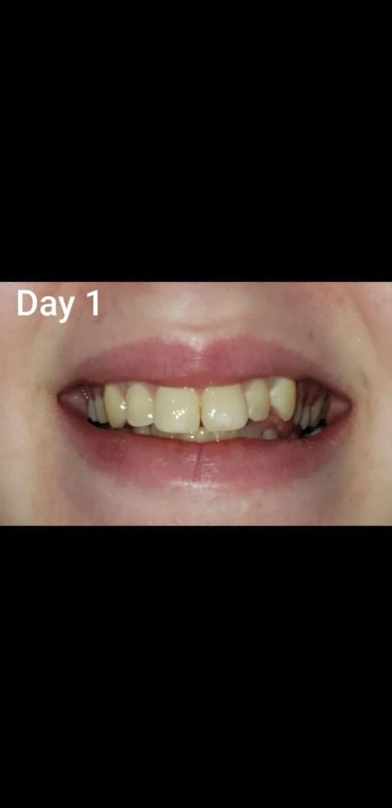 26052 using charcoal for whitening