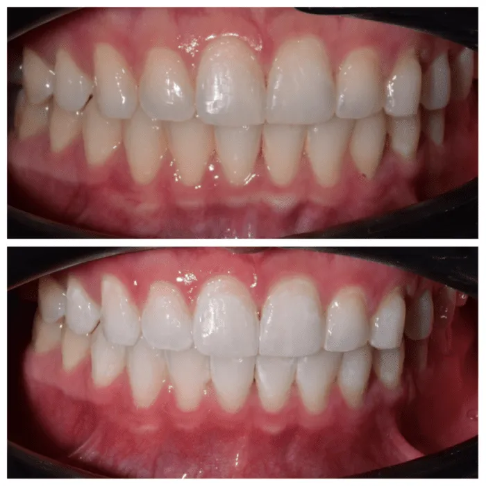 26054 sensitive teeth remedies