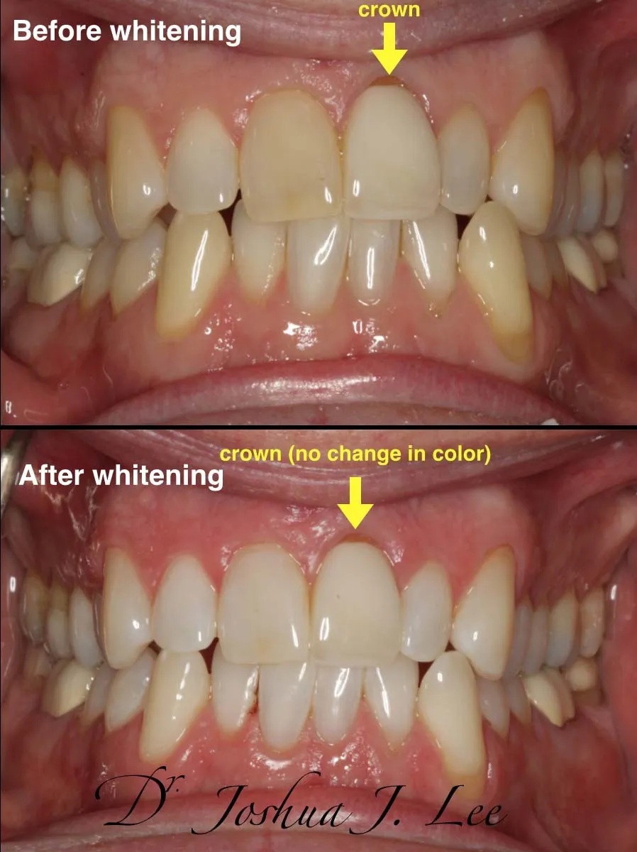 26054 zoom whitening aftercare