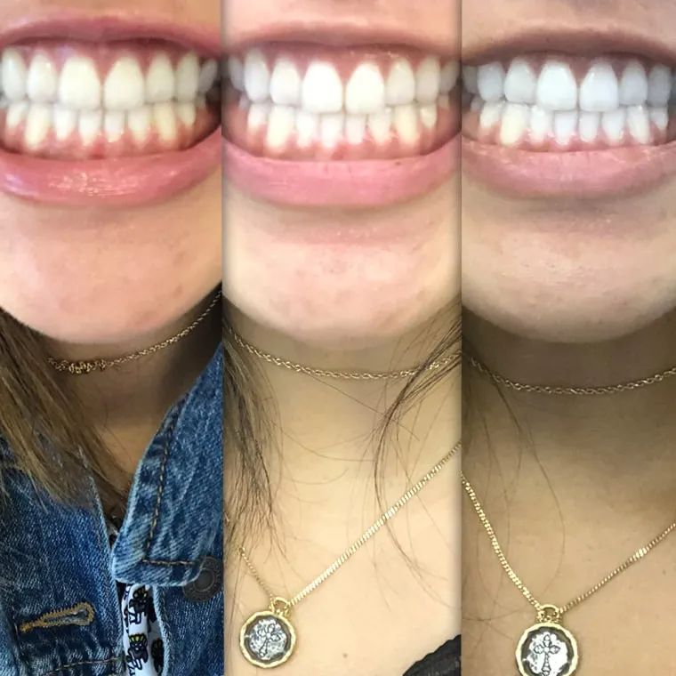 /img/26061-post-whitening-care-image7.webp