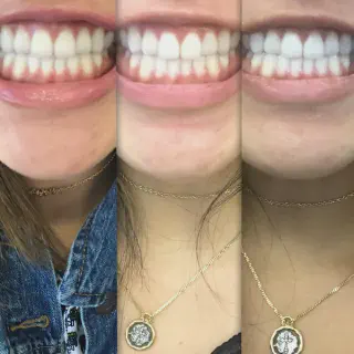 /img/26061-post-whitening-care-image7.webp