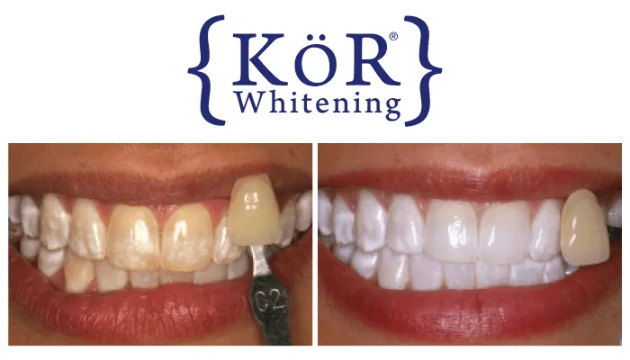 26064 kor teeth whitening at home