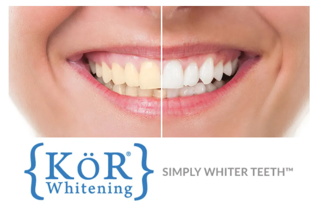 26064 kor teeth whitening before after