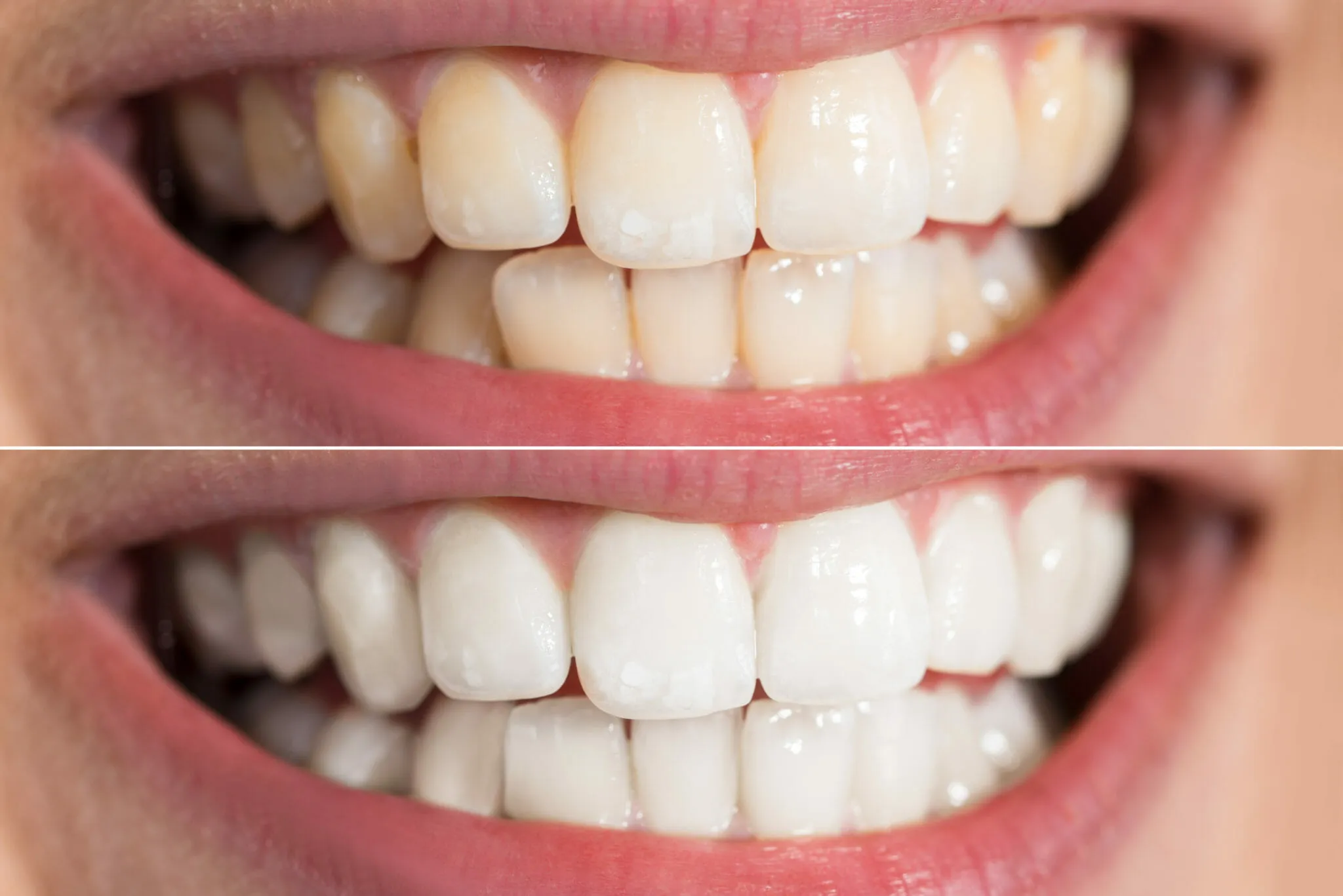 26064 kor teeth whitening comparison