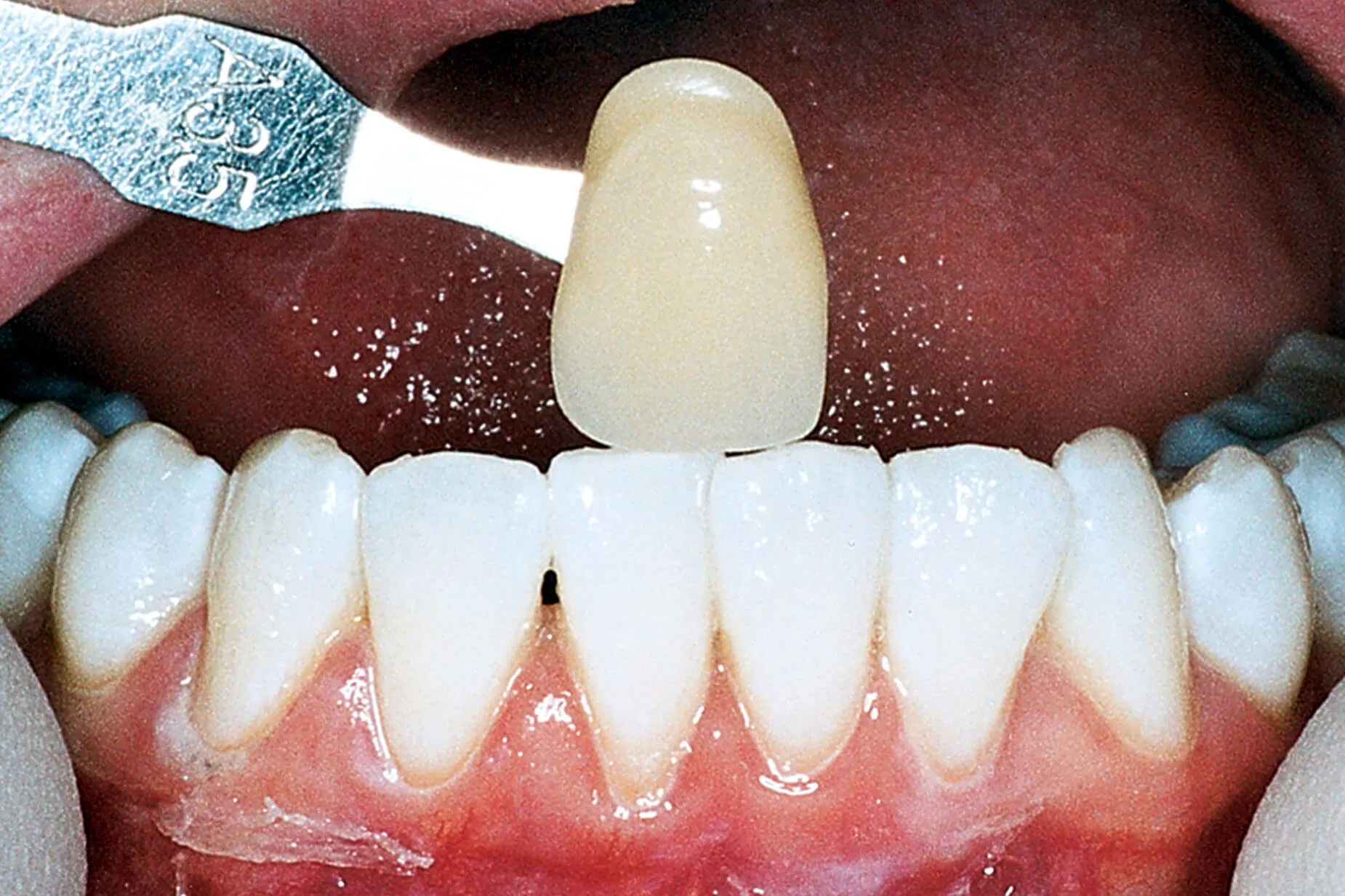 /img/26064-teeth-whitening-results.webp