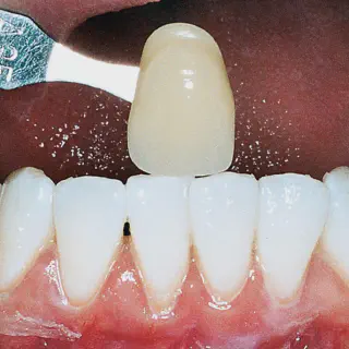 /img/26064-teeth-whitening-results.webp