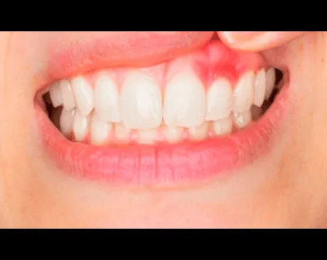 26067 whitening schedule