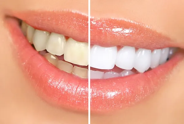 26071 tooth sensitivity explanation