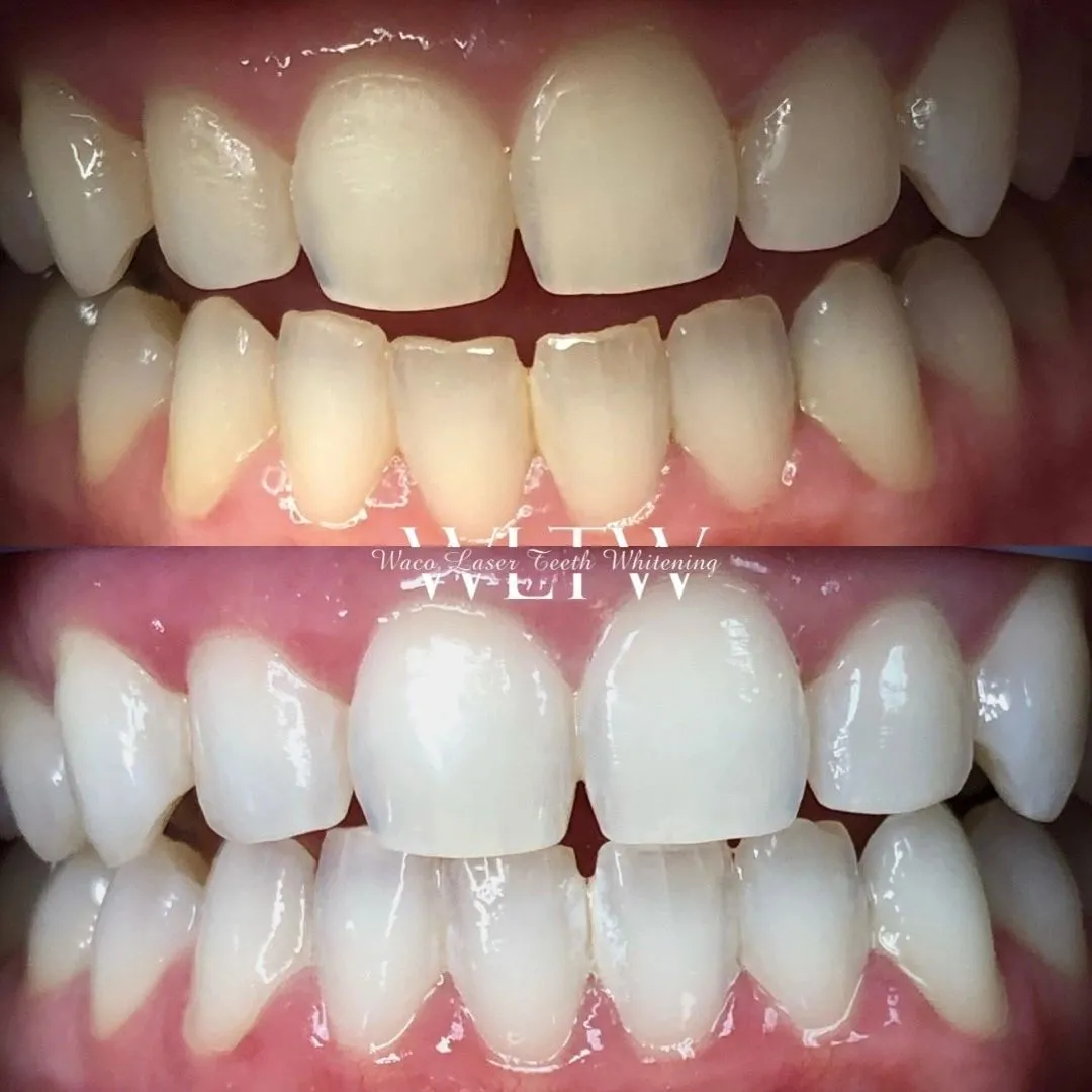 26073 waco teeth whitening smiling woman