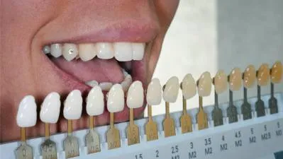 26075 at home teeth whitening kits