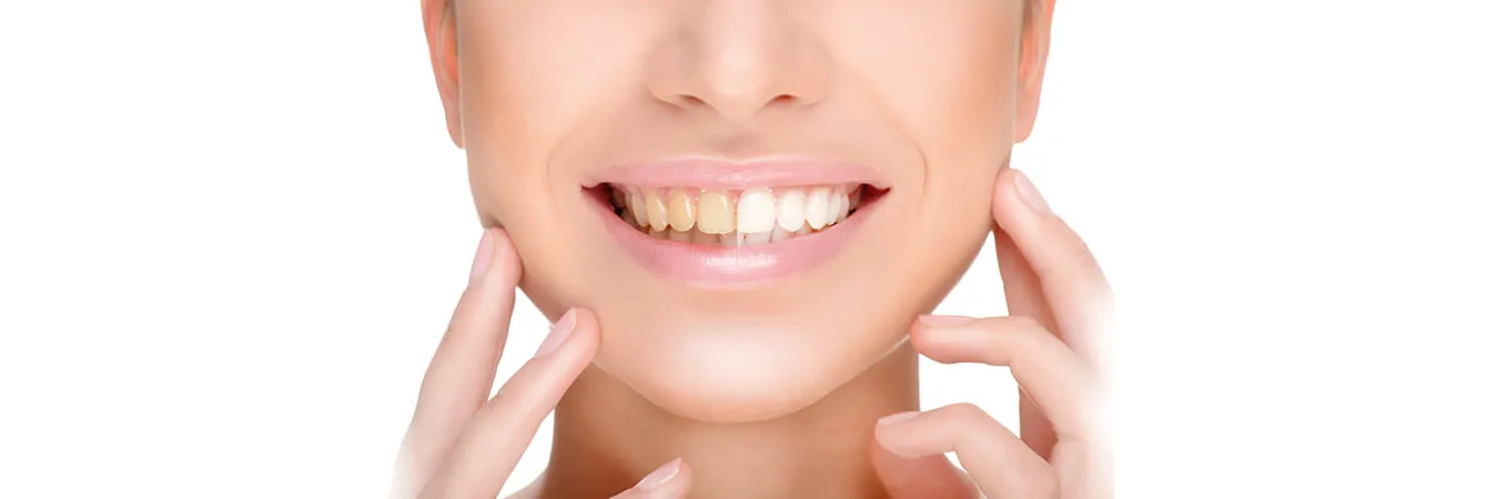 26077 at home teeth whitening springfield mo