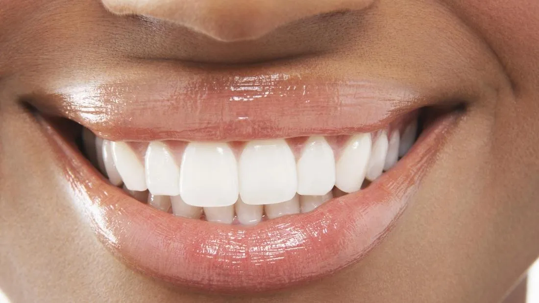 26077 in office teeth whitening springfield mo