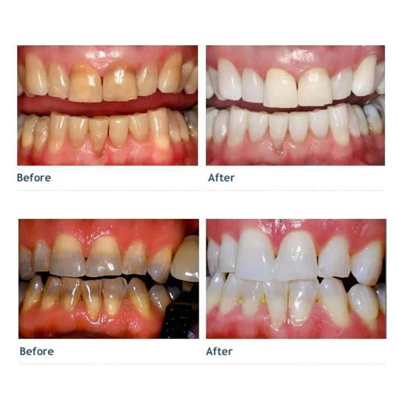 26089 nano teeth whitening before after