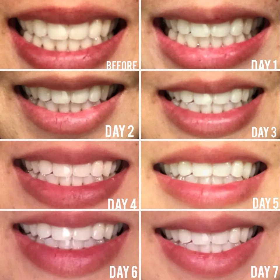 26091 applying whitening strips