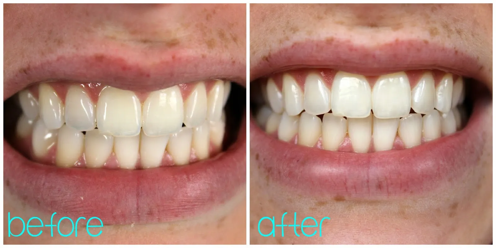 26097 at home teeth whitening