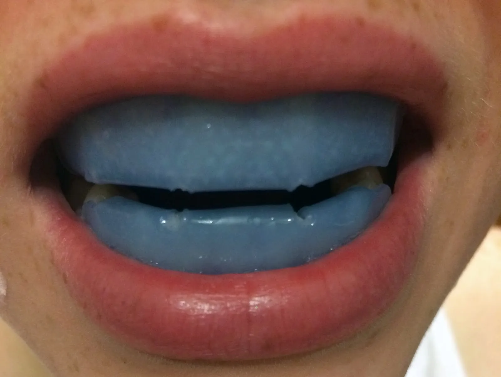 26097 teeth whitening results