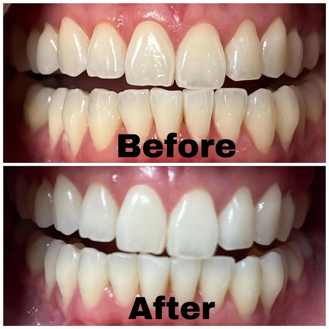 /img/26100-foods-to-avoid-after-whitening.webp
