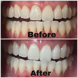 /img/26100-foods-to-avoid-after-whitening.webp
