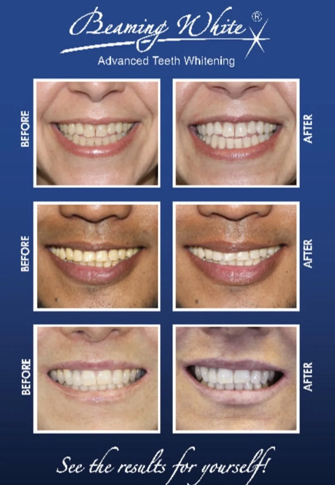 26100 teeth whitening maintenance