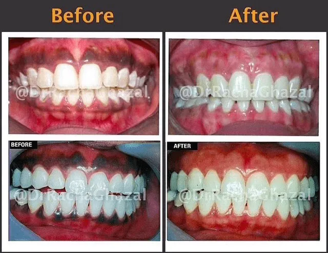 26102 laser whitening session
