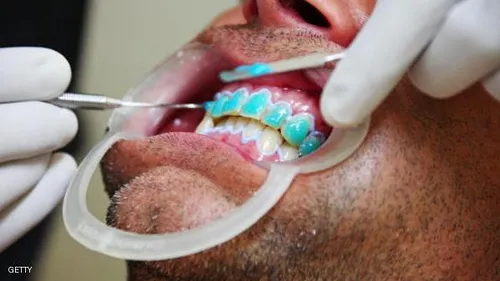 26108 tooth whitening utah 5