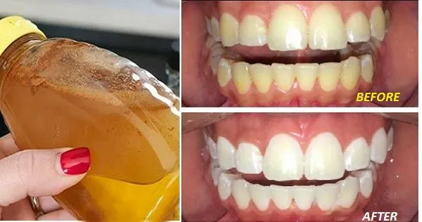 26110 acv teeth whitening before after 2
