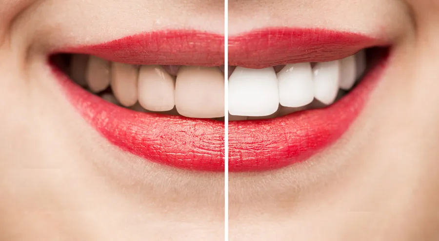 26110 acv teeth whitening before after 3