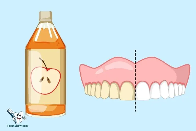 26110 acv teeth whitening before after 6
