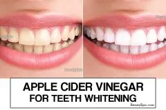 26110 acv teeth whitening before after 7