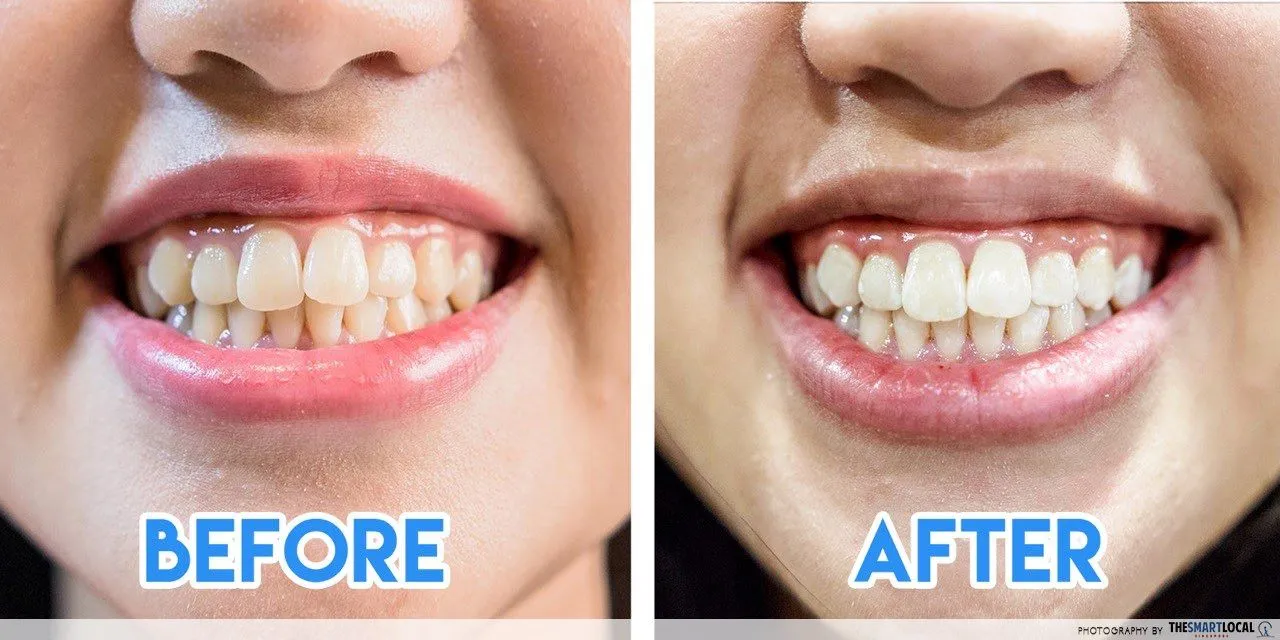 /img/26110-acv-teeth-whitening-before-after-8.webp