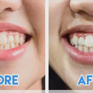 /img/26110-acv-teeth-whitening-before-after-8.webp