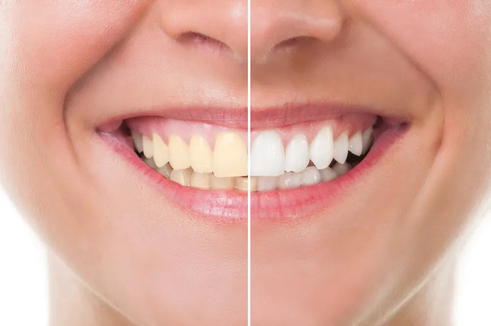 26119 nyc teeth whitening cost 3