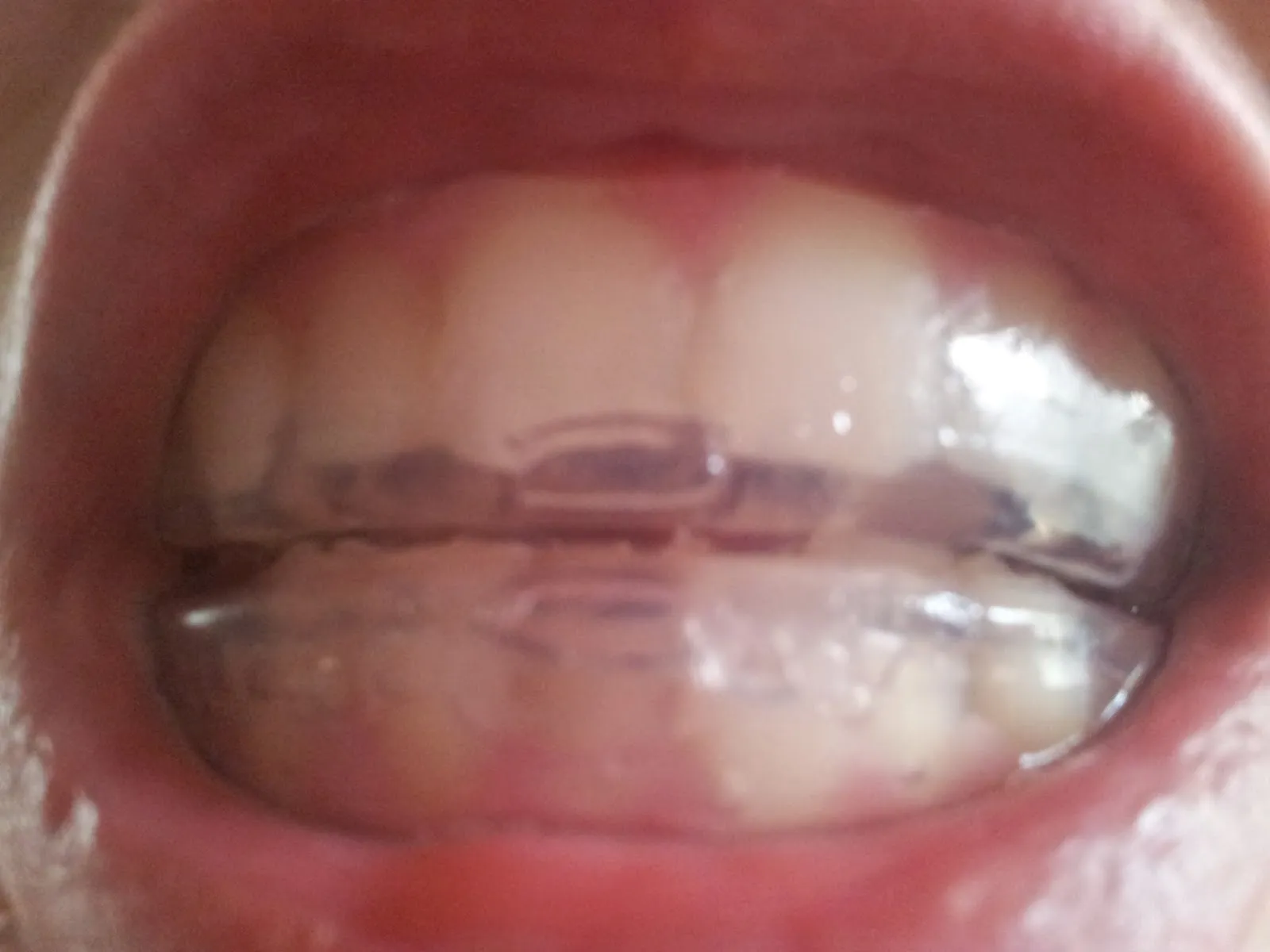 26120 briyte mouth tray