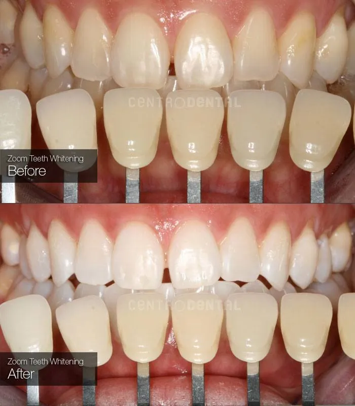 26125 gentle brushing techniques