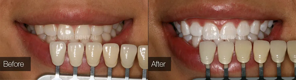 26125 maintaining oral hygiene