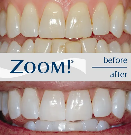 26126 professional teeth whitening