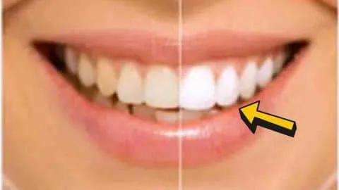 26127 teeth whitening before after