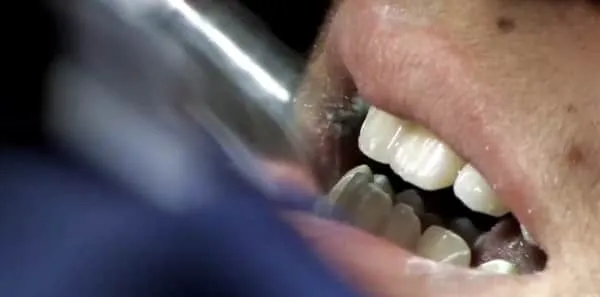 /img/26128-laser-teeth-whitening-options.webp