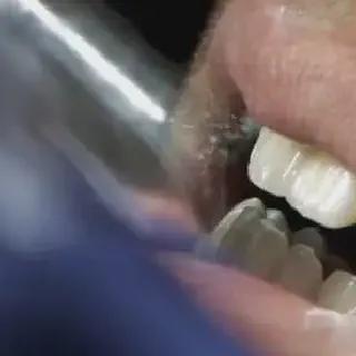 /img/26128-laser-teeth-whitening-options.webp
